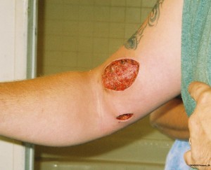 Brown recluse Spider Bite